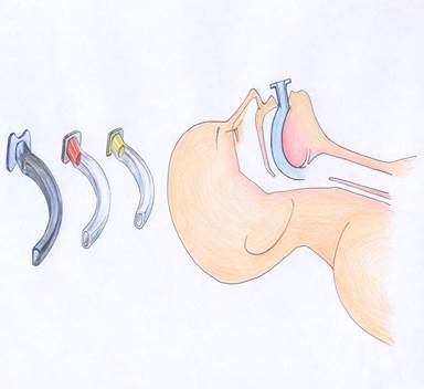 Description: https://www.aic.cuhk.edu.hk/web8/Hi%20res/Guedel%20airway.jpg